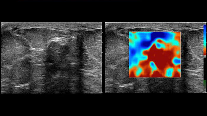 Aplikacja Q-App Elastography Analysis &mdash; miniatura