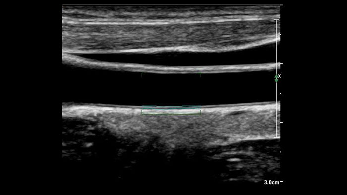 Aplikacja Q-App Imtima Media Thickness &mdash; miniatura