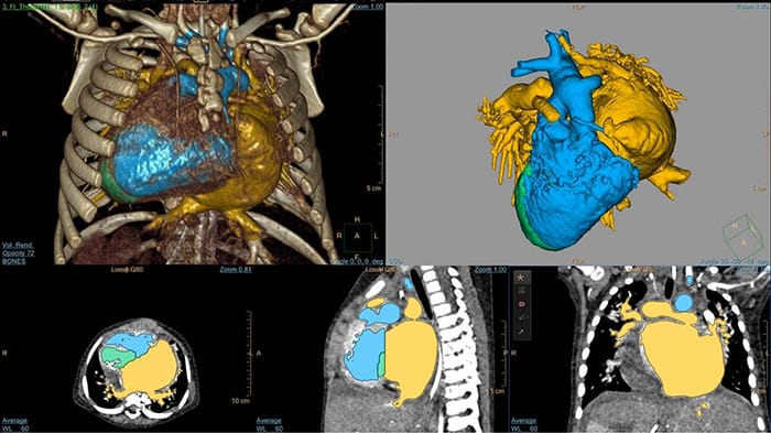 Obrazowanie serca &mdash; system ISP