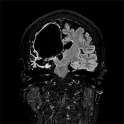 M&oacute;zg przypadek kliniczny