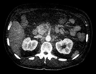 Badanie wykonane metodą &bdquo;Iodine no H20&rdquo;