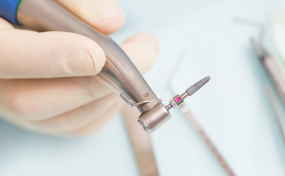 Implant zęba przygotowywany przez stomatologa do zabiegu wszczepienia.