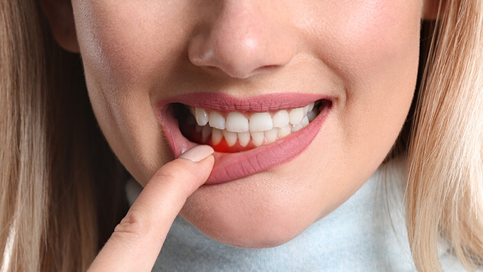 Krwawiące dziąsła. Przyczyny, objawy, leczenie